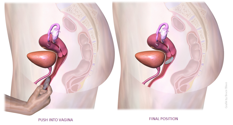 vaginalring